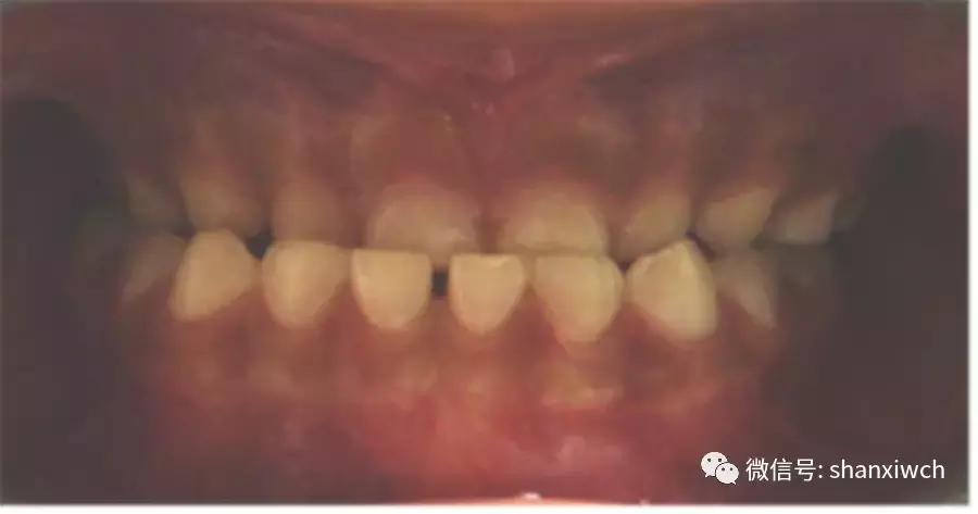 育儿知识关于牙齿,育儿知识幼儿牙齿敏感期