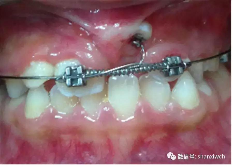 育儿知识关于牙齿,育儿知识幼儿牙齿敏感期