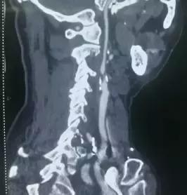 西安市第三人民医院血管外科,治疗颈动脉斑块西安哪家医院好