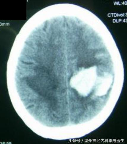 脑出血李医生,脑出血病例分析及答案