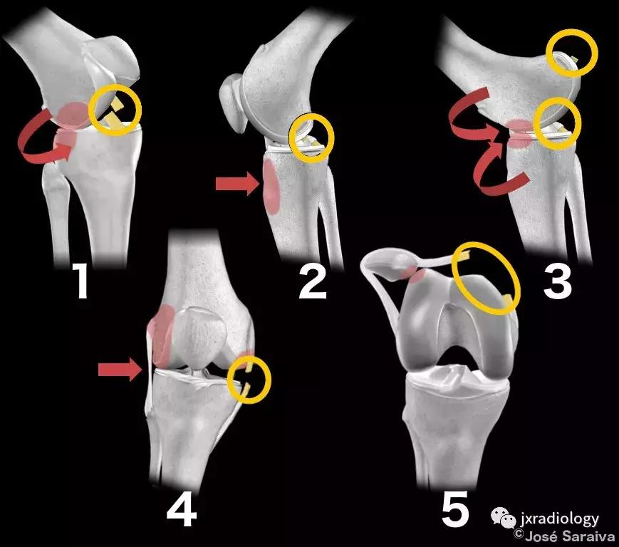 膝关节骨髓水肿疼痛特点,膝关节骨髓水肿的临床表现