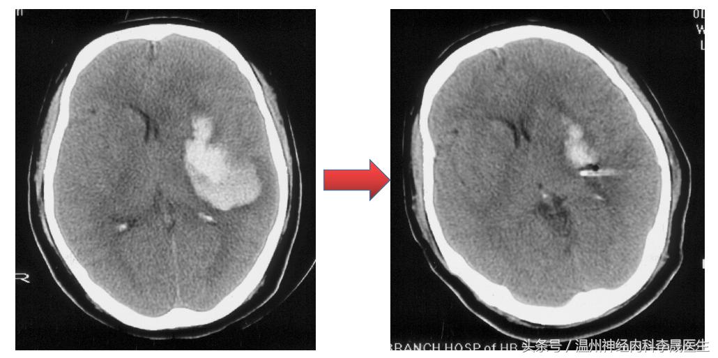 专家讲解中医治疗脑出血视频,医生对脑出血病人的治疗