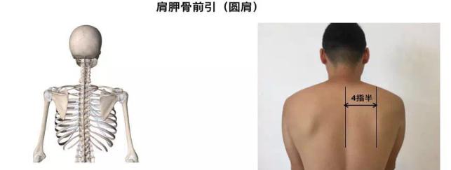 康复医生纠正驼背,如何矫正驼背简单办法