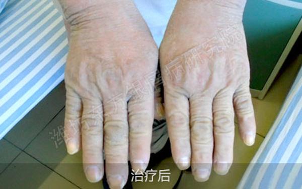 关节型牛皮癣用什么药,牛皮癣的种类和特征