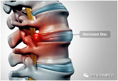 左腰背部疼痛是什么原因引起的,湿气重会腰背部疼痛吗