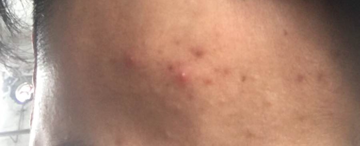 还在为长痘而烦恼吗,脸上长痘一招帮你远离痘痘肌