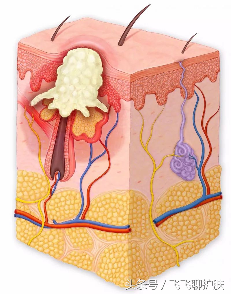 只有长痘才知道痘痘有多难治,要知道痘痘的根源