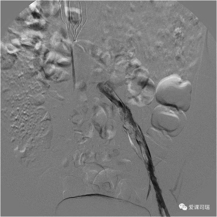 爱老师敲黑板,脚踝两侧变黑溃烂怎么回事