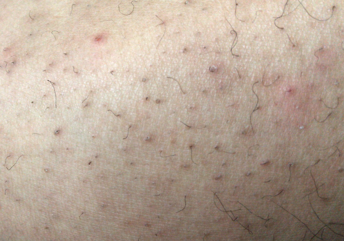 汗毛缩在毛囊里是怎么回事,汗毛蜷缩在毛囊里怎么办能治好吗