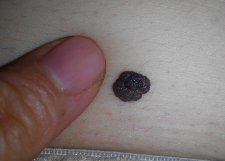 嘴上一个黑痣,嘴上有一颗很大的痣去掉后的图