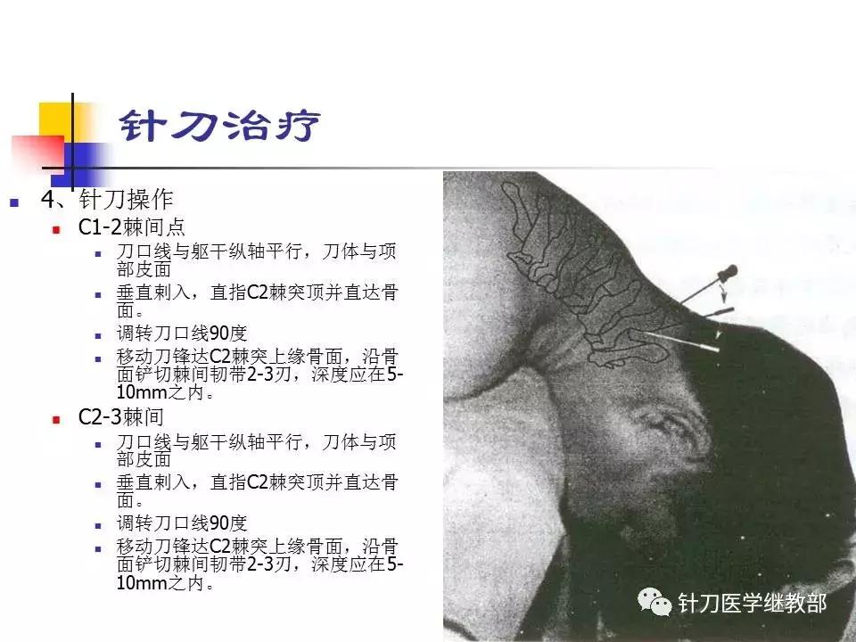 椎动脉型颈椎病错位了怎么治疗,颈椎寰枢关节错位复位手法