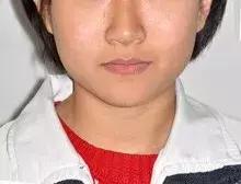 牙齿正畸堪比整容,牙齿矫正堪比整形