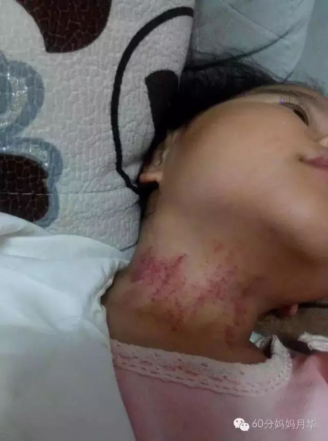 扁桃体炎引起的高烧不退咽喉脓肿，只能靠吃药吗？！