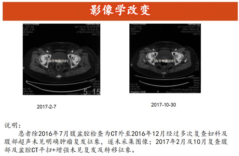 子宫内膜癌nccn指南2020中文版,子宫内膜癌b期怎么样