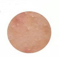 去闭口痘痘毛孔粗大,祛闭口痘痘的真实感受