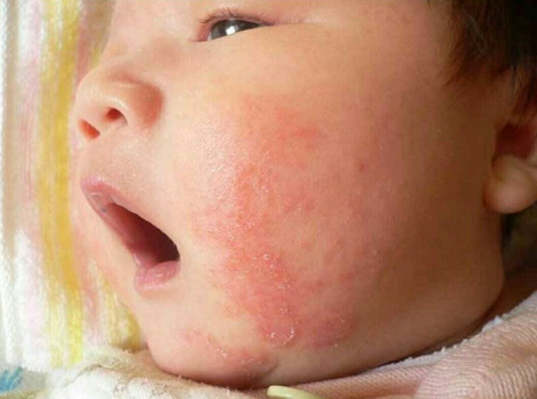 宝妈湿疹反复发作怎么办,母乳宝宝反复湿疹最佳治疗方法