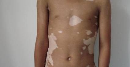 邯郸中医院发现白癜风,邯郸白癜风需要在哪里治疗