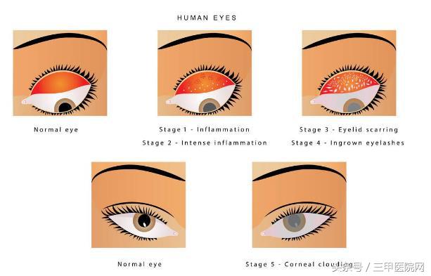 沙眼不治的后果是什么,沙眼要去眼科医院治疗吗