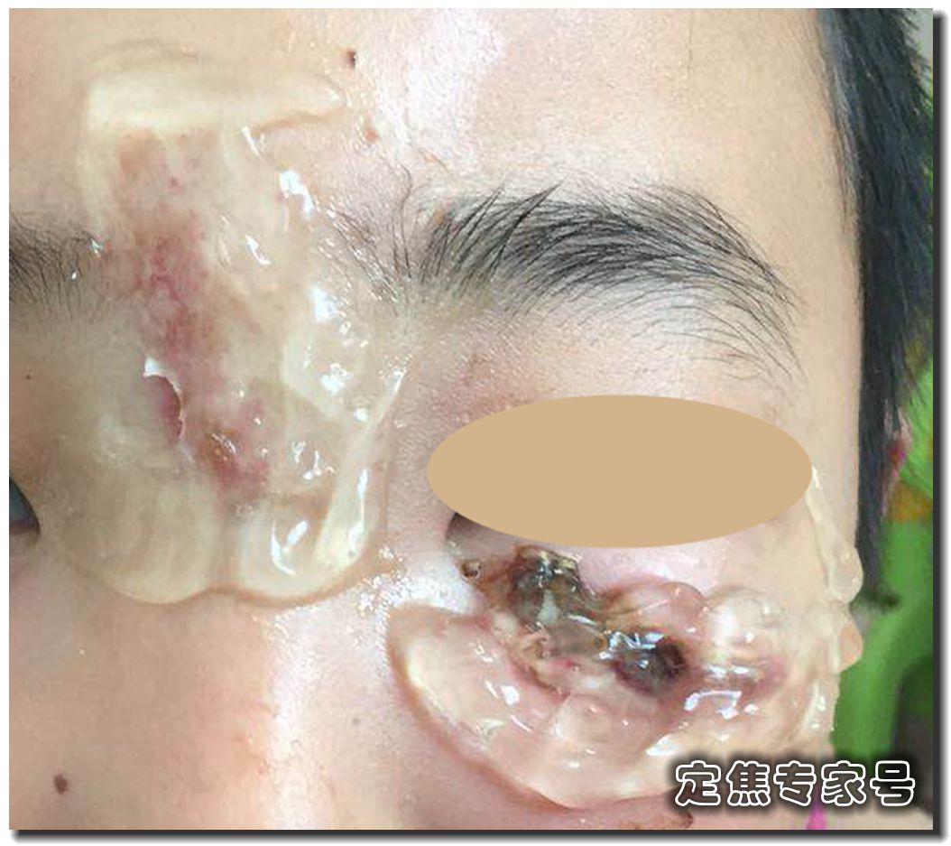 小孩摔伤防留疤擦芦荟胶可以吗,孩子受伤妈妈擦药