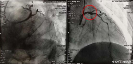 劳累后胸闷心悸是什么原因,劳累后心悸气短吃什么药