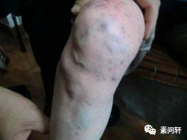 像蚯蚓一样的凸起的纹,像蚯蚓一样黑色的是什么