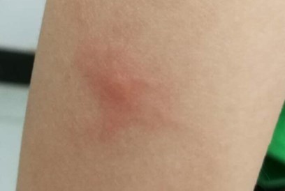 蚊子咬了很大的疙瘩是荨麻疹吗,被蚊子咬后就成荨麻疹