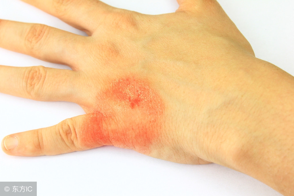 手足癣传播途径为,手足癣怎么预防感染