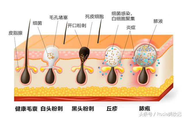 脸上长闭口粉刺应该怎么办,消灭额头粉刺闭口