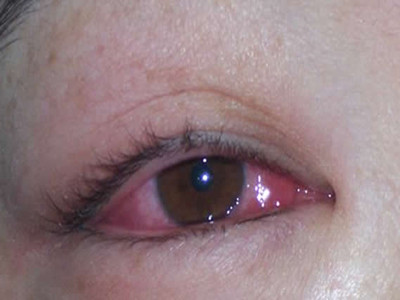 儿童红眼病眼睛里出血怎么办,小孩得了红眼病眼睛肿怎么办