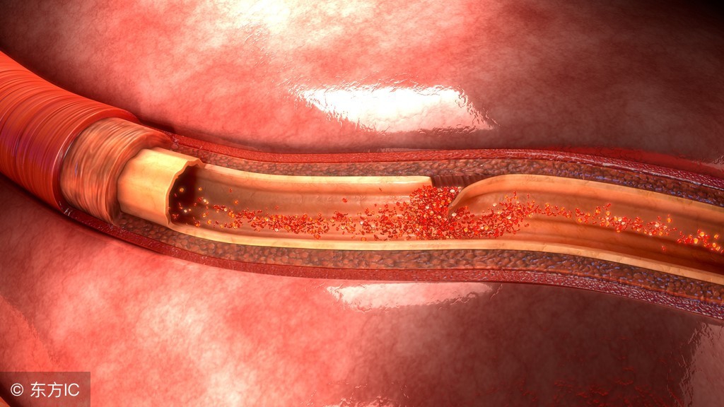 脑梗塞患者最佳睡姿,脑梗塞老年患者采取体位
