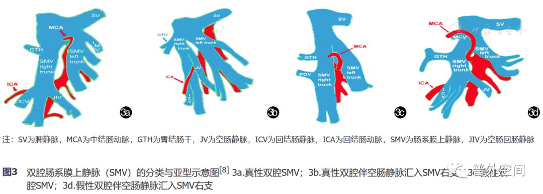 腹腔镜完整结肠系膜切除术相关血管变异与术中出血的应对措施（上）