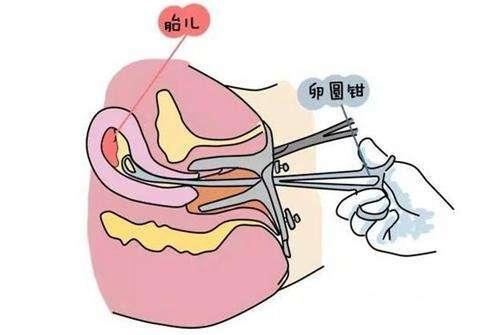 女人应该是流产几次就不能生孩子,女人一生可以承受几次打胎之痛