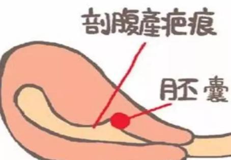 瘢痕子宫合并宫内早孕,瘢痕子宫单角子宫怀孕危险