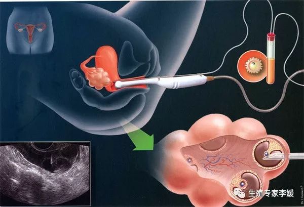 人工授精失败还能自然怀孕吗,人工授精失败后可以自然怀孕吗