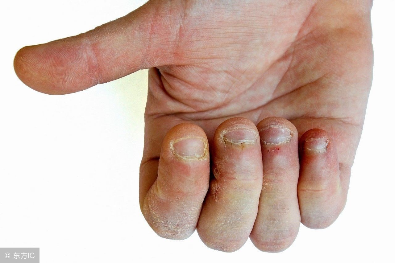从手指的半月痕来看身体健康,这几种半月痕要注意一下
