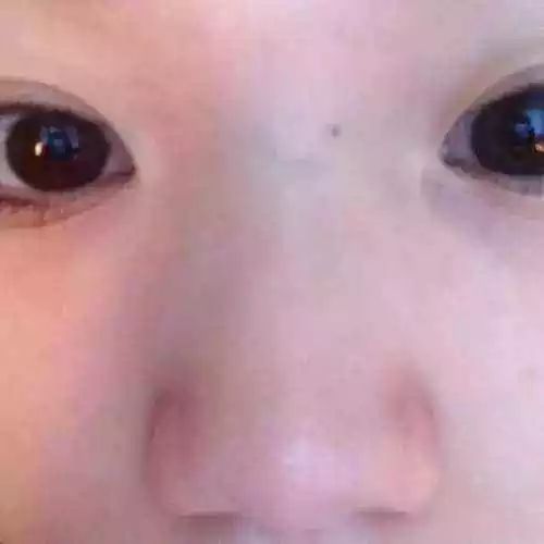 小孩鼻梁上竖着一道青是怎么回事,孩子天生鼻梁上青是怎么回事