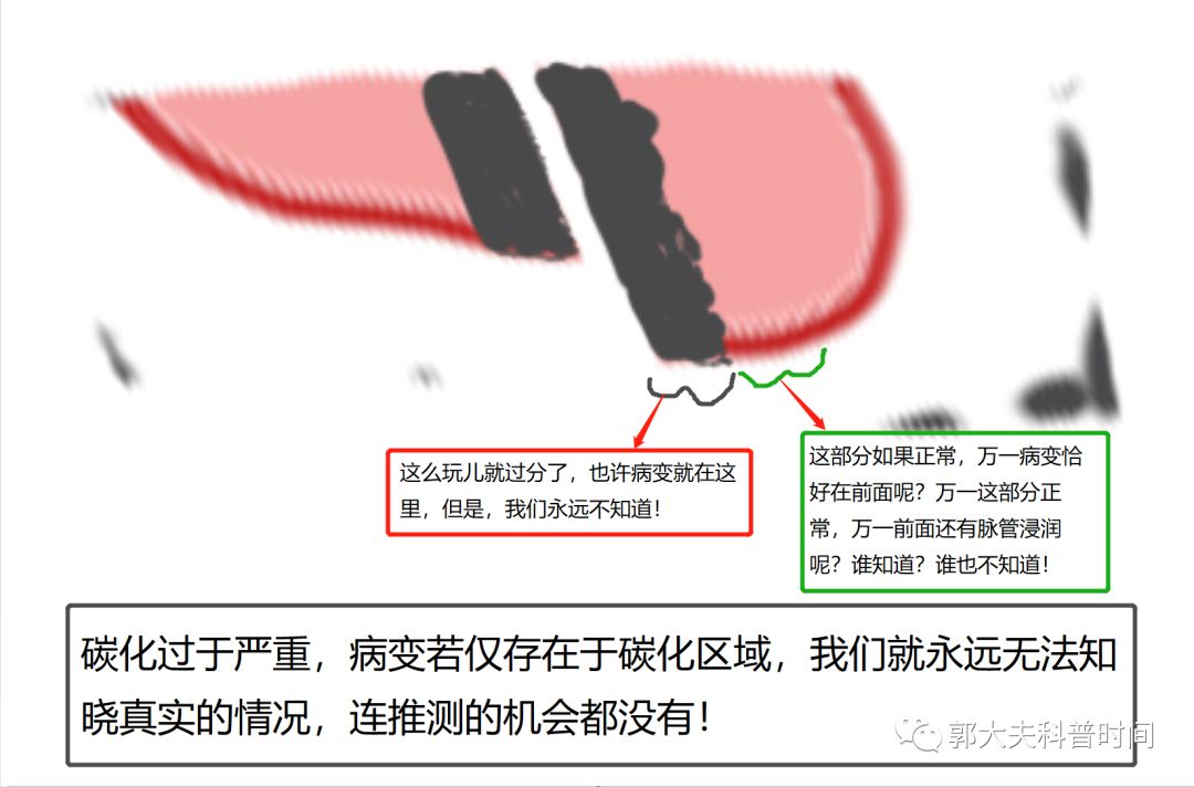 leep手术和激光手术有什么区别,leep手术的好处与坏处