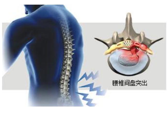 腰椎间盘突出腰腿麻木怎么治疗,腰椎间盘突出疼痛最快治疗方法