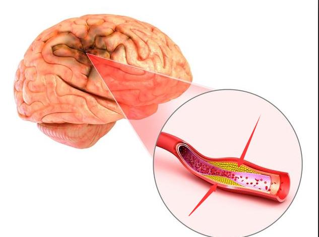 脑血栓和脑梗怎么彻底治疗,脑血栓和脑梗能治好吗