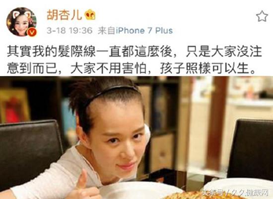 胡杏儿发际线缩水原因,胡杏儿回应产后发际线后移