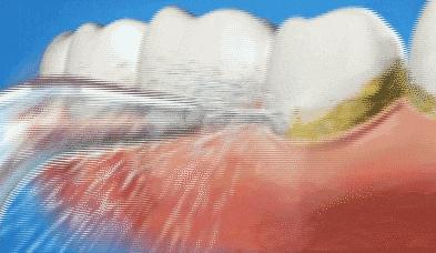 洗牙健康吗,健康洗牙