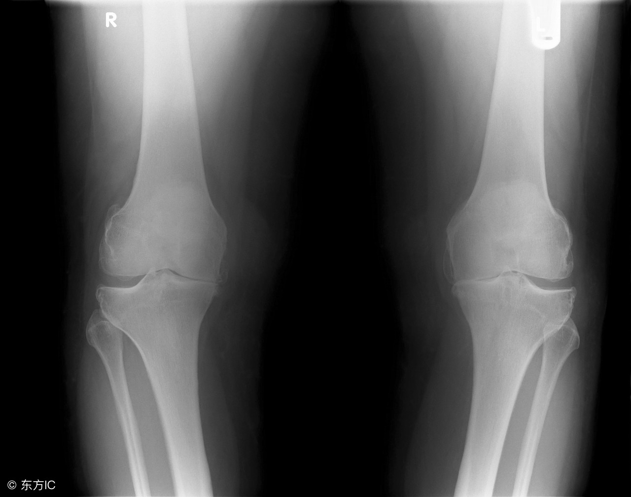 膝盖处骨刺最好的医疗方法是什么,请问专业的医生骨刺怎么处理呢