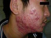 维生素缺乏神经性皮炎,治疗口腔溃疡脚气病的维生素