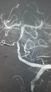 与死神角力！景德镇市一院卒中中心成功挽救一名急性脑梗死患者