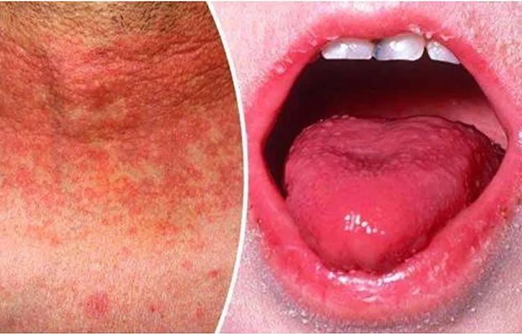 猩红热疾病注意事项,猩红热死亡率下降的原因