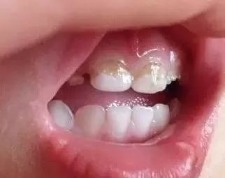 哺乳期蛀牙什么原因,蛀牙完全是因为吃糖吗