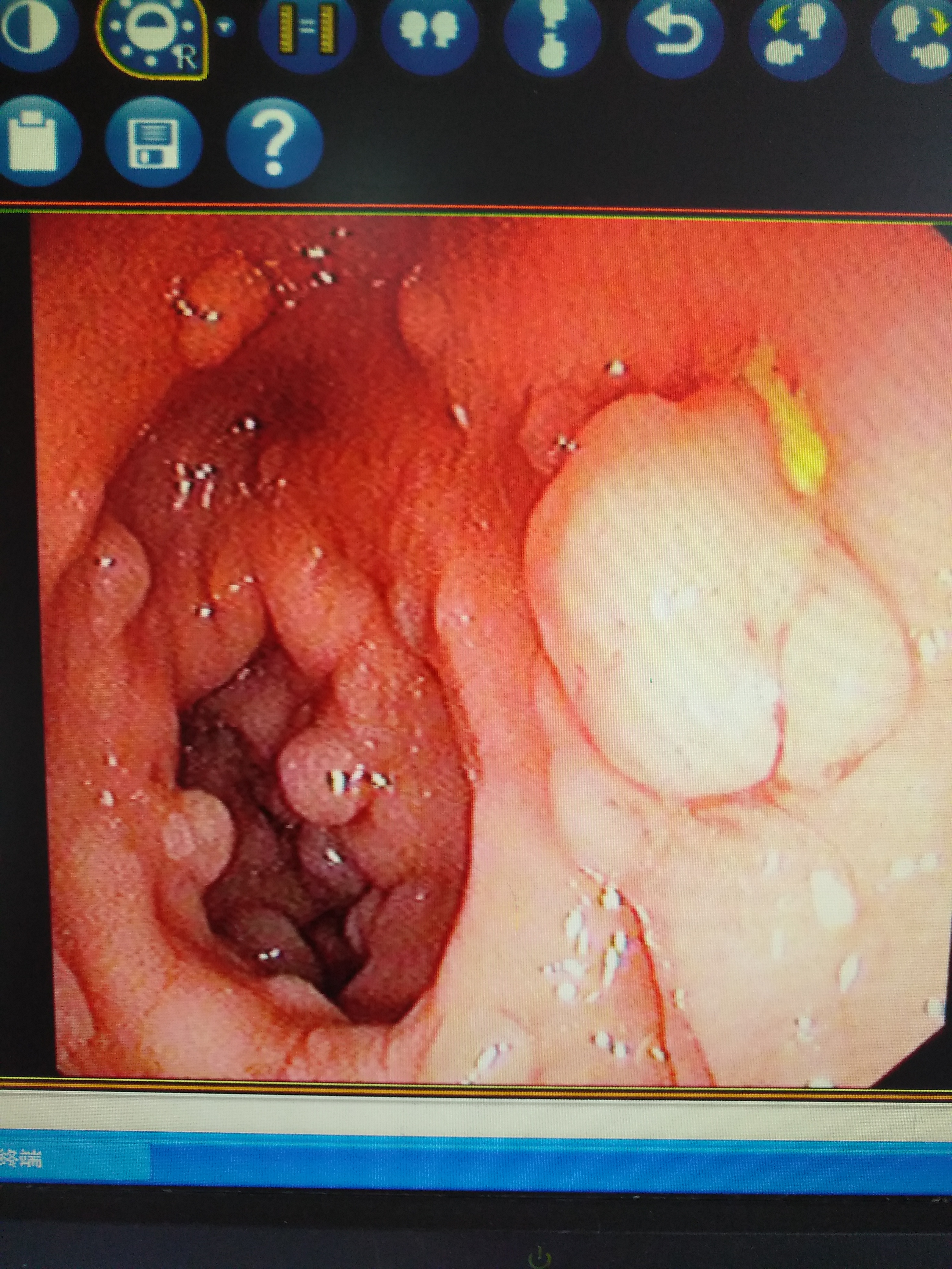 嘴唇上有黑斑是有癌症了吗,嘴唇有黑斑是肠道有病吗
