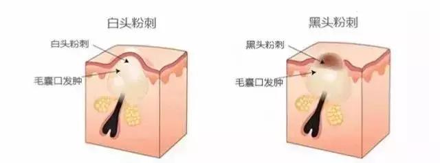 去除闭口有什么最简单的好办法,如何简单有效去闭口