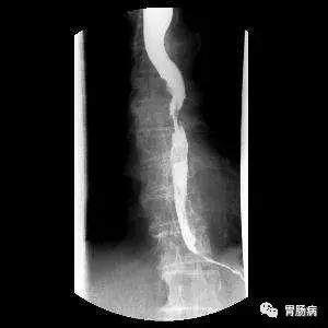 食管癌发病症状,当心吞咽困难是食管癌的典型症状