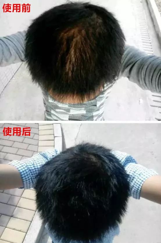 脱发、发际线高、地中海的克星！用它，1个月头发不掉了，不痒了，半年变浓密